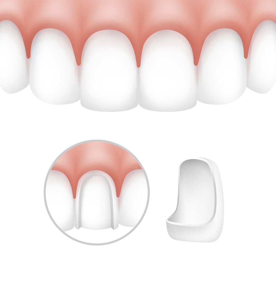 Сколько могут болеть зубы после установки виниров